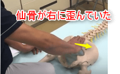 骨盤の歪み